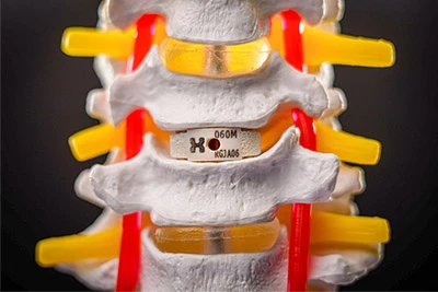 Anatomical model of cervical vertebrae with an artificial spinal disc implant. Yellow intervertebral discs and red spinal nerves are visible.